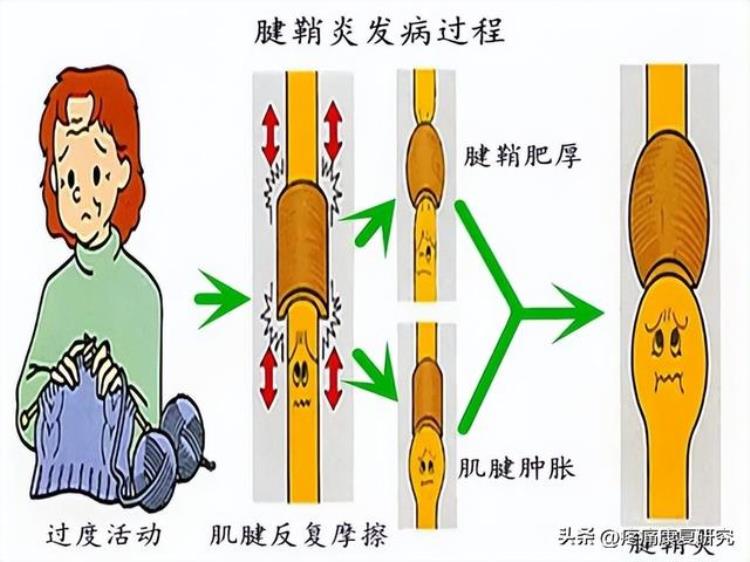 低头族与颈椎病和手腕腱鞘炎有关吗?「低头族与颈椎病和手腕腱鞘炎」