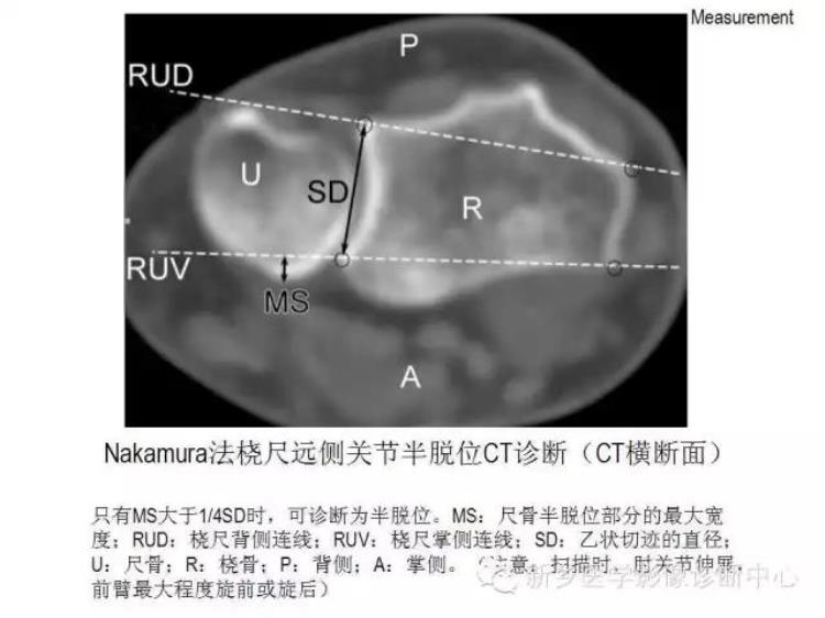 腕关节x线报告模板「详细的腕关节X线解剖摄影技巧阅片技巧测量」