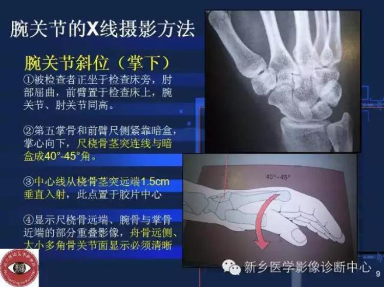 腕关节x线报告模板「详细的腕关节X线解剖摄影技巧阅片技巧测量」