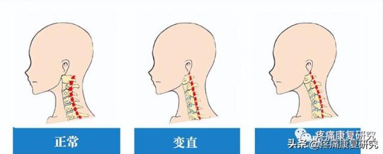 低头族与颈椎病和手腕腱鞘炎有关吗?「低头族与颈椎病和手腕腱鞘炎」