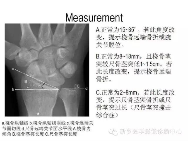 腕关节x线报告模板「详细的腕关节X线解剖摄影技巧阅片技巧测量」