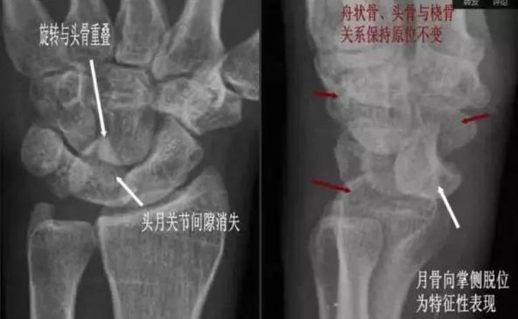 腕关节x线报告模板「详细的腕关节X线解剖摄影技巧阅片技巧测量」