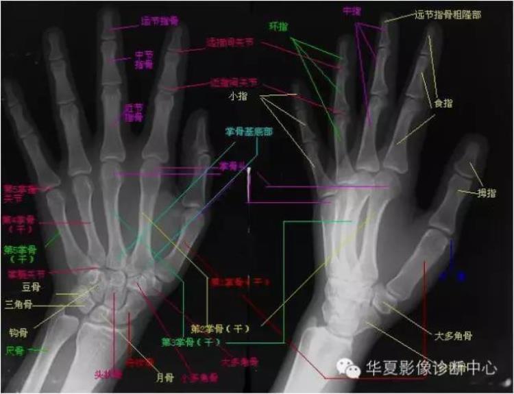 腕关节x线报告模板「详细的腕关节X线解剖摄影技巧阅片技巧测量」