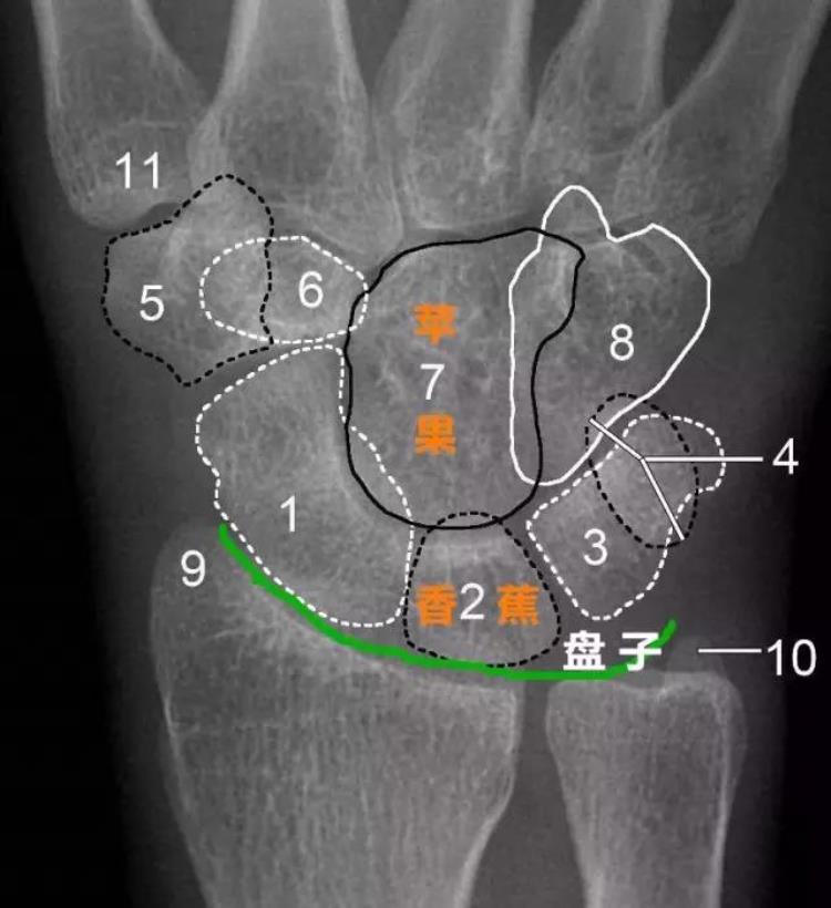 腕关节x线报告模板「详细的腕关节X线解剖摄影技巧阅片技巧测量」