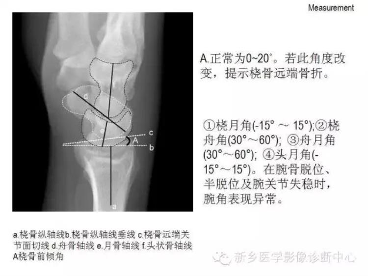 腕关节x线报告模板「详细的腕关节X线解剖摄影技巧阅片技巧测量」