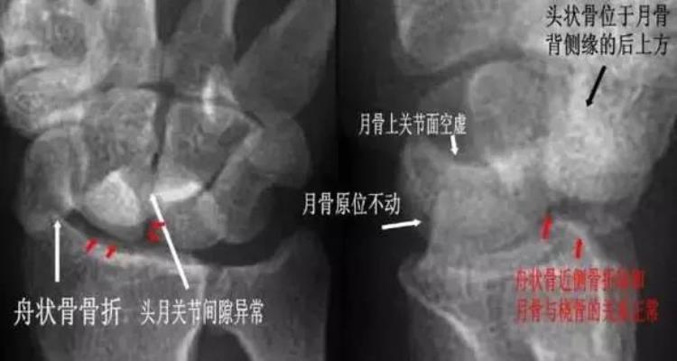 腕关节x线报告模板「详细的腕关节X线解剖摄影技巧阅片技巧测量」