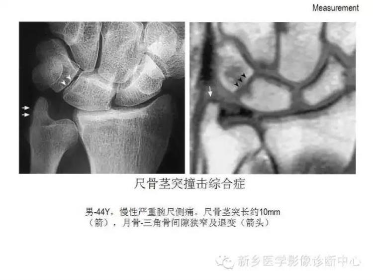 腕关节x线报告模板「详细的腕关节X线解剖摄影技巧阅片技巧测量」