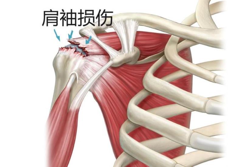 脑梗塞后遗症偏瘫在家怎么样锻炼「脑梗后偏瘫早期锻炼时注意这四点可有效避免手和上肢的并发症」