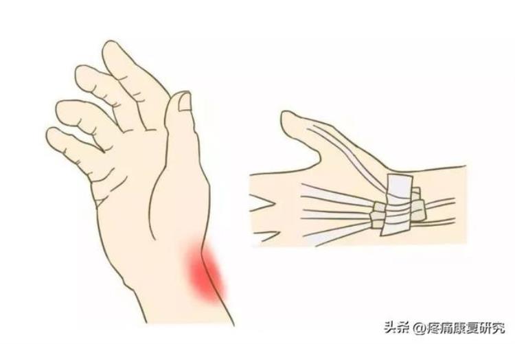 低头族与颈椎病和手腕腱鞘炎有关吗?「低头族与颈椎病和手腕腱鞘炎」