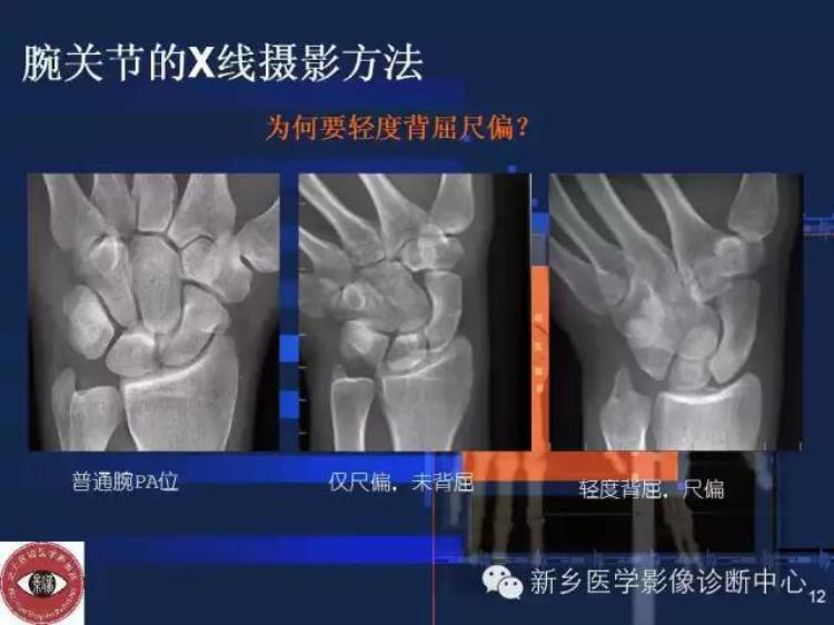 腕关节x线报告模板「详细的腕关节X线解剖摄影技巧阅片技巧测量」