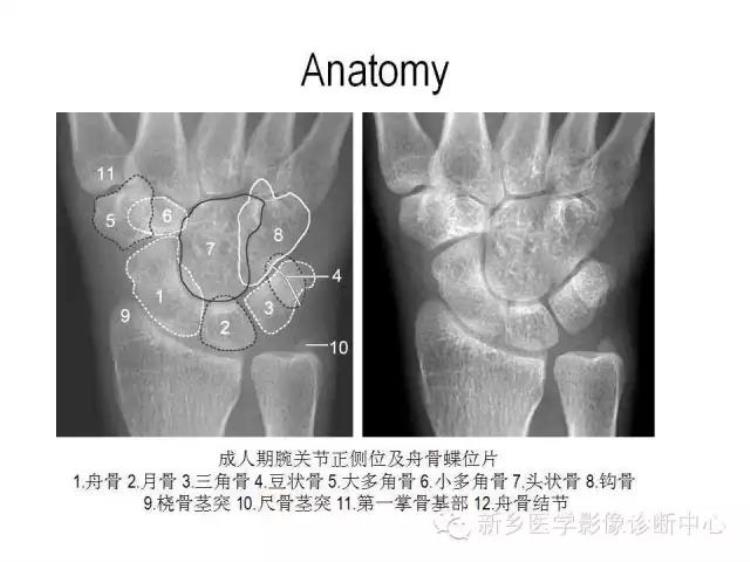 腕关节x线报告模板「详细的腕关节X线解剖摄影技巧阅片技巧测量」