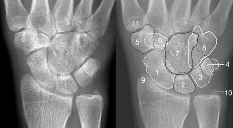 腕关节x线报告模板「详细的腕关节X线解剖摄影技巧阅片技巧测量」