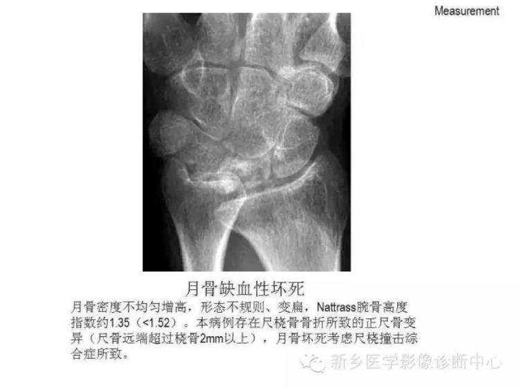 腕关节x线报告模板「详细的腕关节X线解剖摄影技巧阅片技巧测量」