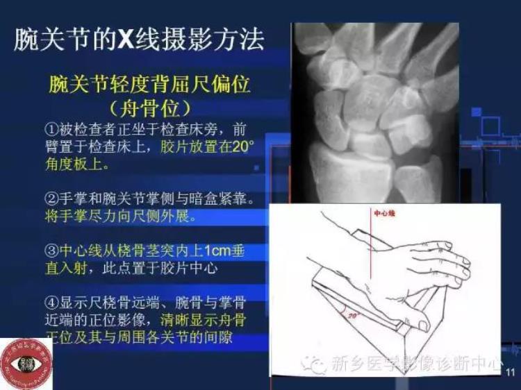 腕关节x线报告模板「详细的腕关节X线解剖摄影技巧阅片技巧测量」