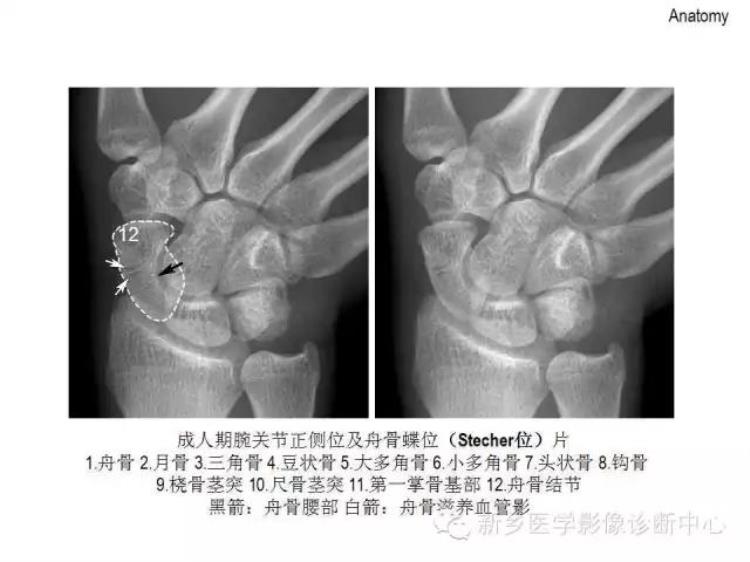 腕关节x线报告模板「详细的腕关节X线解剖摄影技巧阅片技巧测量」