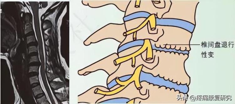 低头族与颈椎病和手腕腱鞘炎有关吗?「低头族与颈椎病和手腕腱鞘炎」