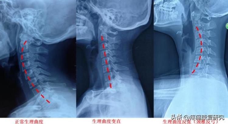 低头族与颈椎病和手腕腱鞘炎有关吗?「低头族与颈椎病和手腕腱鞘炎」