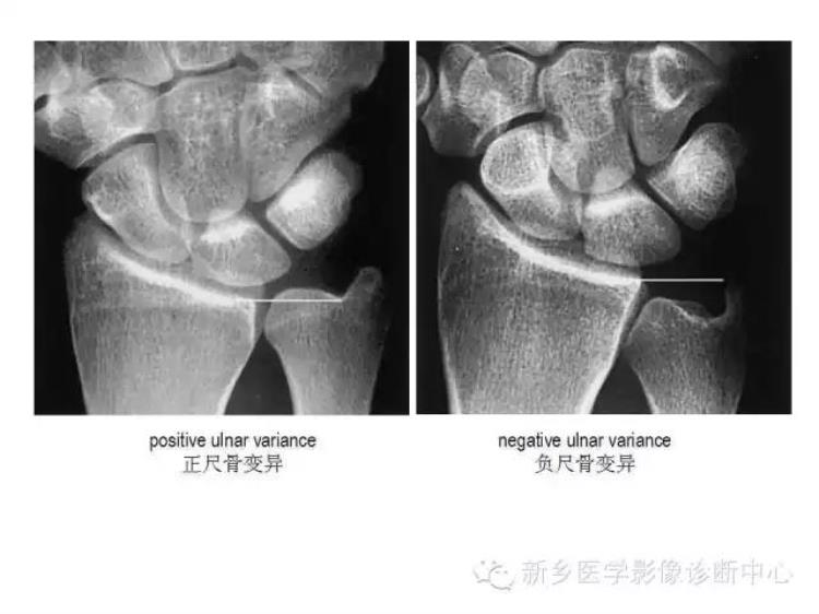 腕关节x线报告模板「详细的腕关节X线解剖摄影技巧阅片技巧测量」