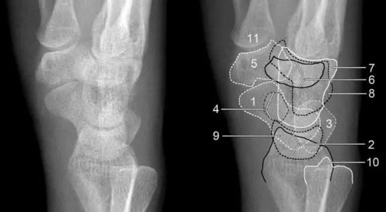 腕关节x线报告模板「详细的腕关节X线解剖摄影技巧阅片技巧测量」