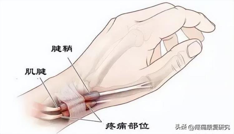 低头族与颈椎病和手腕腱鞘炎有关吗?「低头族与颈椎病和手腕腱鞘炎」