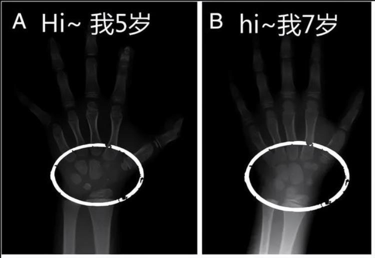 骨龄测一下多少钱「骨龄检测有必要做吗测一次骨龄多少钱」