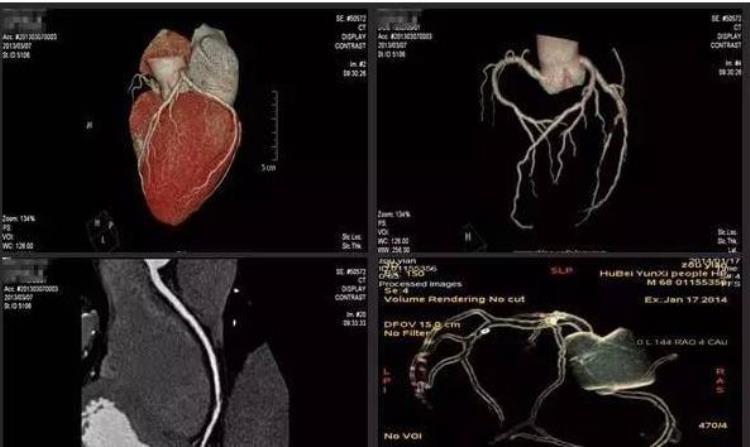 造影心血管堵塞50%什么概念「查心脏血管堵塞4000多的心脏造影和1500的CTA有啥不一样」