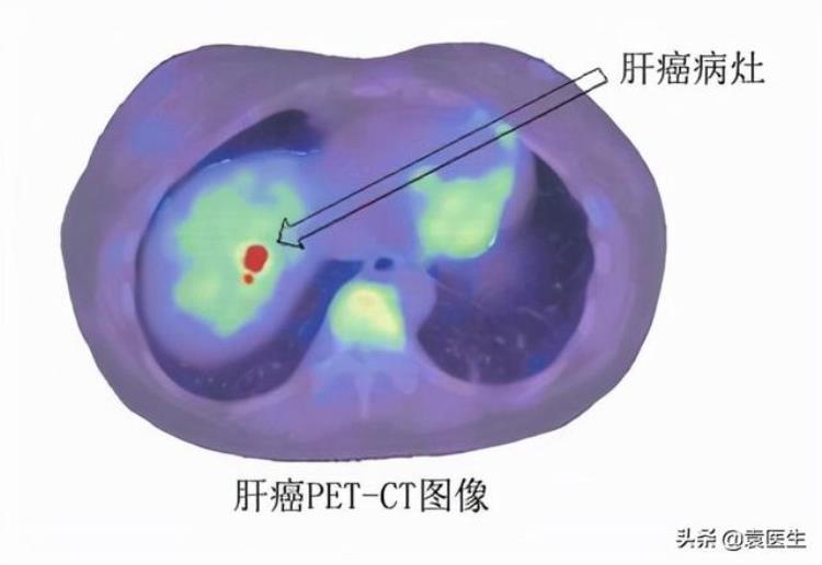 petct体检多少钱「8000多做一次的PETCT是体检神器医生带你揭开真面目」