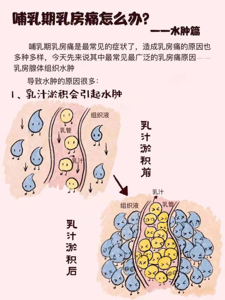 母乳喂养乳房肿胀原因及处理措施「世界母乳喂养周哺乳期乳房痛怎么办水肿篇」