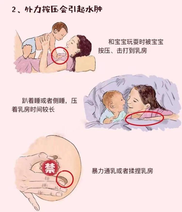 母乳喂养乳房肿胀原因及处理措施「世界母乳喂养周哺乳期乳房痛怎么办水肿篇」