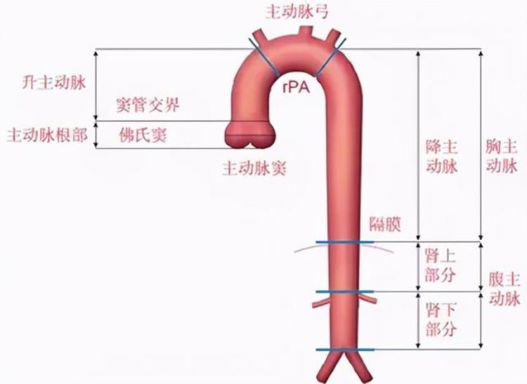 胸痛的四大元凶之首主动脉夹层这样的胸痛必须早确诊早治疗