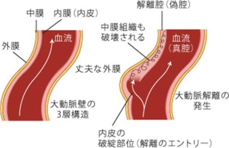 发生主动脉剥离的原因到底是什么?「主动脉剥离发生原因曝医生手绘图秒懂　一发生致死率极高」