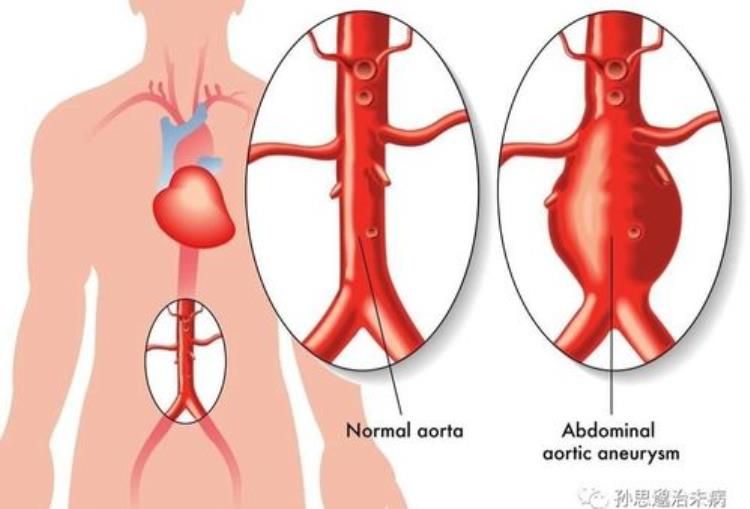 腹主动脉瘤腔内隔绝术后护理「腹主动脉瘤腔内隔绝术如何护理腹主动脉瘤开刀危险吗」