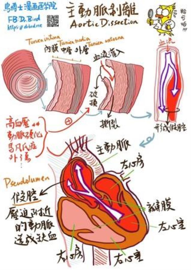 发生主动脉剥离的原因到底是什么?「主动脉剥离发生原因曝医生手绘图秒懂　一发生致死率极高」