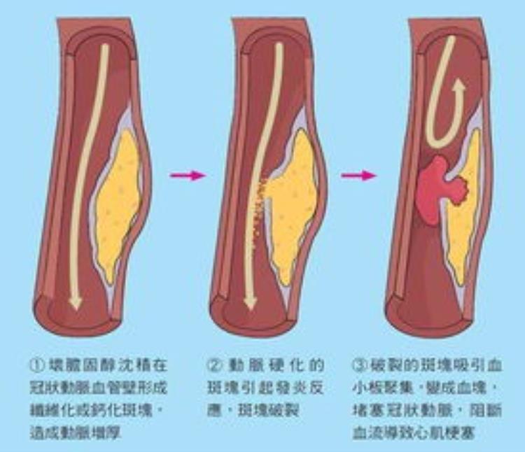 心脏出问题祸首竟是口腔细菌感染「心脏出问题祸首竟是口腔细菌」