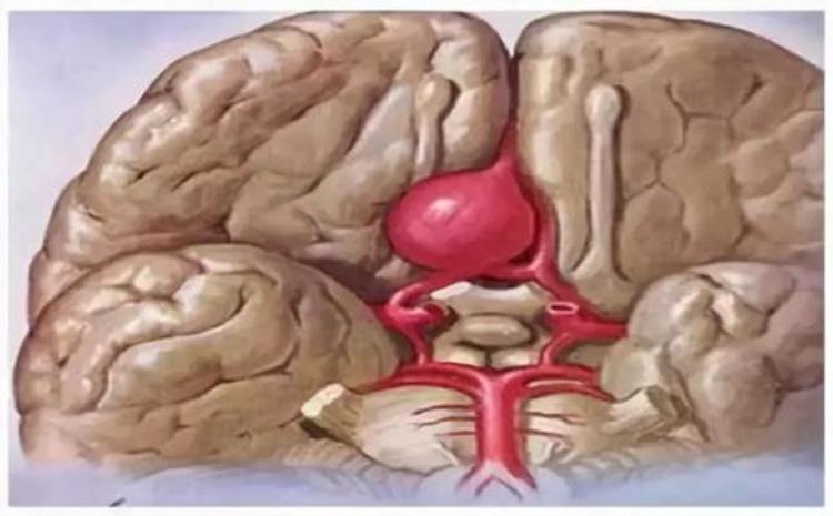 腹主动脉瘤腔内隔绝术后护理「腹主动脉瘤腔内隔绝术如何护理腹主动脉瘤开刀危险吗」