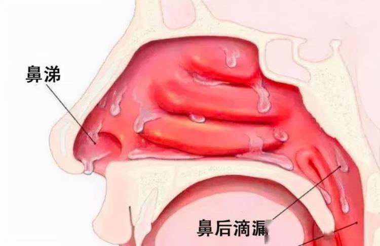 孩子每天早晨嘴臭「孩子早晨总是恶心口臭不一定是肠胃问题可能是这个毛病」