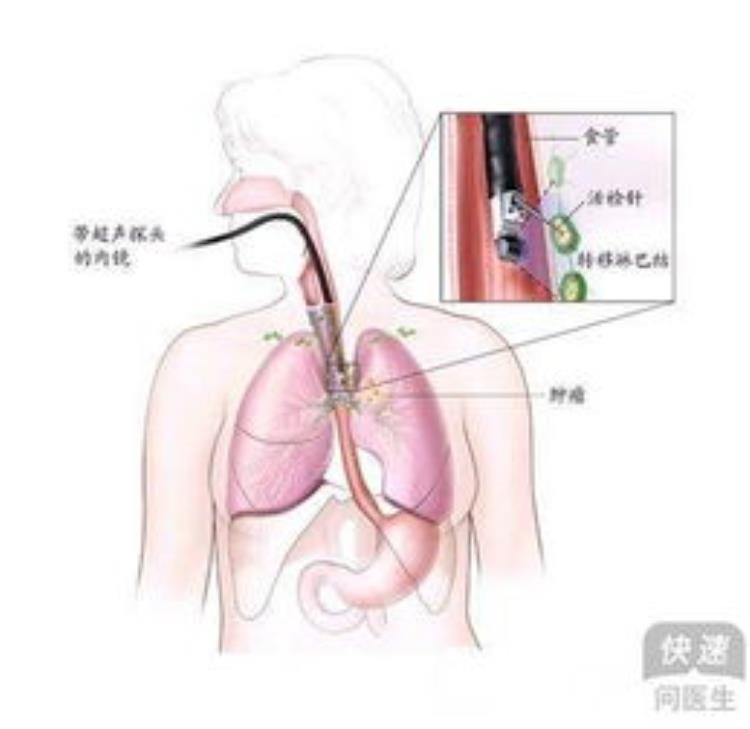 诱发食管癌的八大因素「诱发食管癌的八大因素」