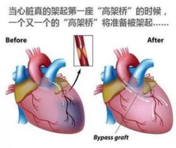 心脏搭桥手术后浑身没劲怎么回事「心脏搭桥术后200天了感觉越来越没有力气到底怎么回事」