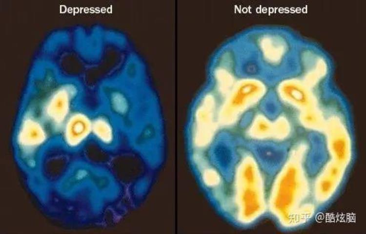 为什么有的人会得抑郁症有的人不会呢「为何有人会得抑郁症除了心理承受力差外还有这些原因」