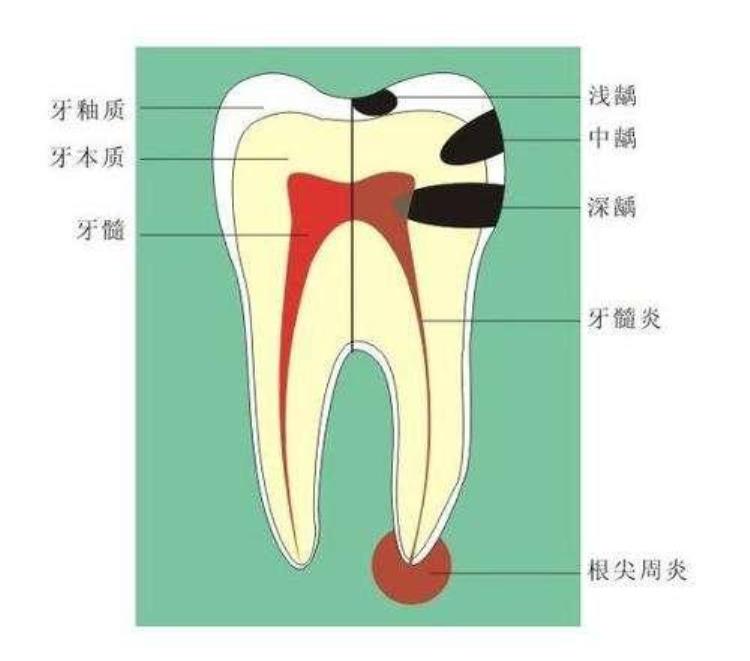 牙齿酸吃东西没劲咋回事「牙齿酸疼吃东西也使不上劲儿到底是什么导致的听听牙医怎么说」