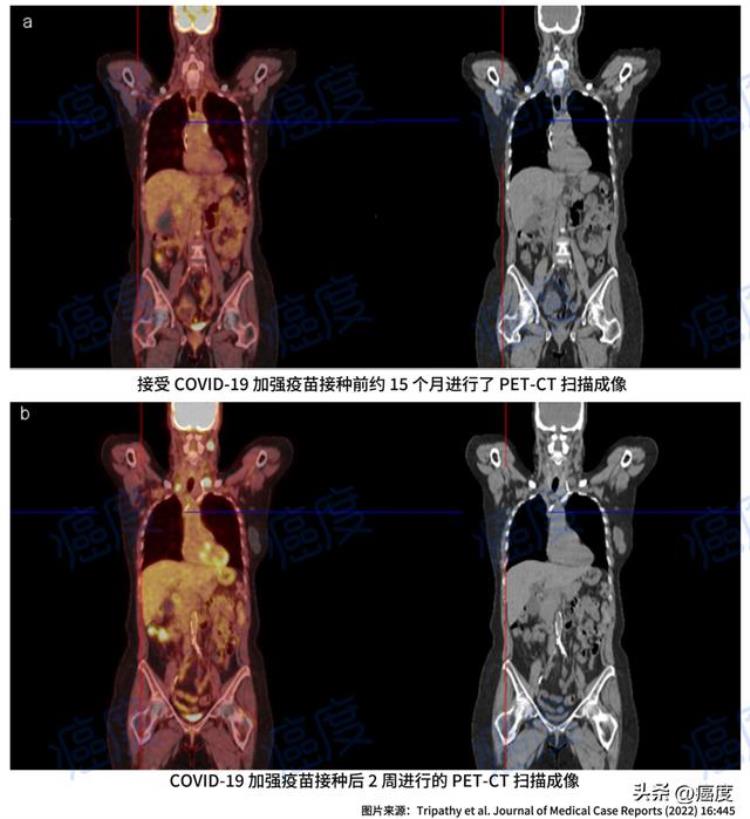 打了新冠疫苗后发现患癌「癌症患者接种新冠疫苗后出现了新病灶是巧合吗」