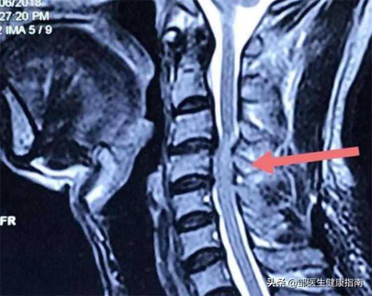 下肢踩棉花感是哪种颈椎病「下肢无力肌肉跳动走路像踩棉花可能是颈椎脊髓压迫症」