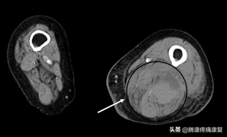 肌肉与疼痛原因诊疗预防汇总表「肌肉与疼痛原因诊疗预防汇总」