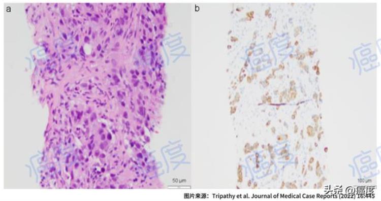 打了新冠疫苗后发现患癌「癌症患者接种新冠疫苗后出现了新病灶是巧合吗」