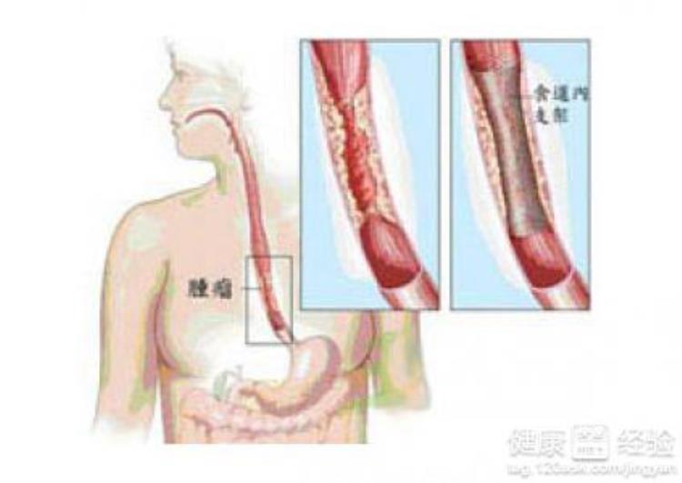 食道癌会有咳嗽症状吗「食道癌患者有咳嗽症状出现吗」