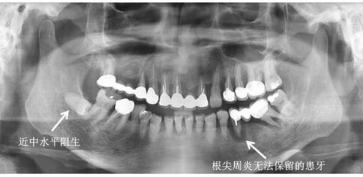 拔牙进ICU「拔牙住进ICU关于拔牙你需要知道这些→」