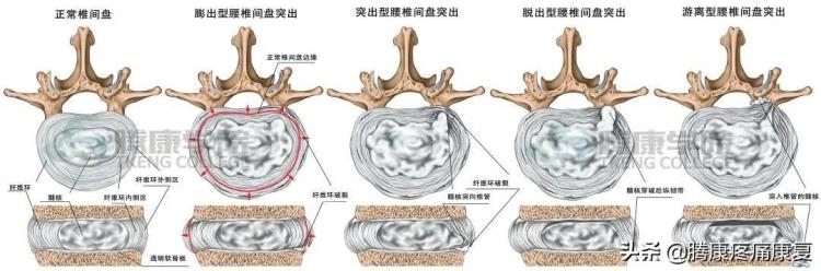 背疼是肌肉劳损吗「是肌肉劳损还是椎间盘突出关于背疼你需要知道这些」