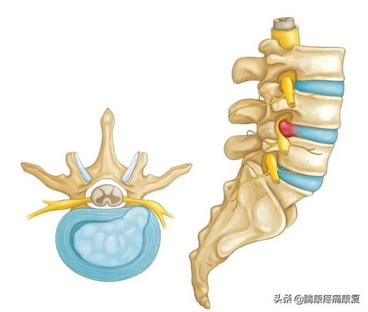 背疼是肌肉劳损吗「是肌肉劳损还是椎间盘突出关于背疼你需要知道这些」