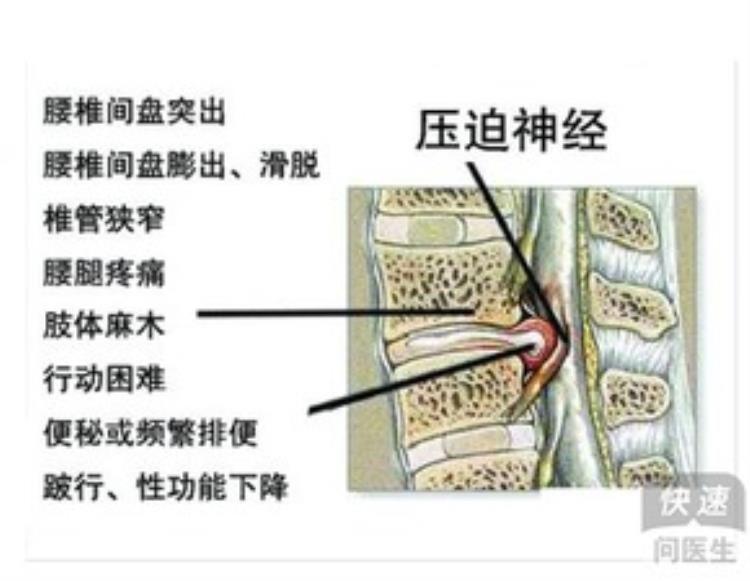 孙思邈的一方可治腰突腰痛腰肌劳损腰椎间盘增生都能搞定