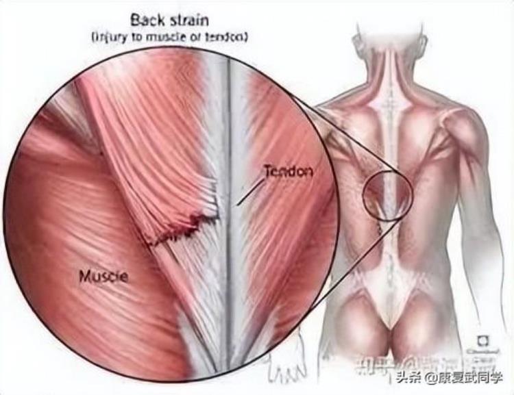 肌肉拉伤如何康复训练「肌肉拉伤的处理方法及其康复训练」